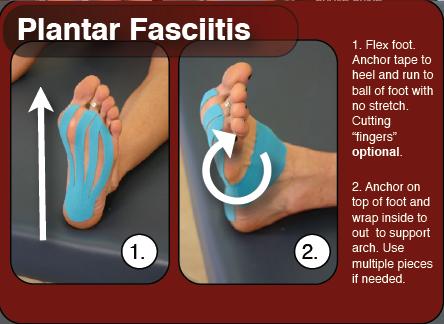 Plantar Fascia