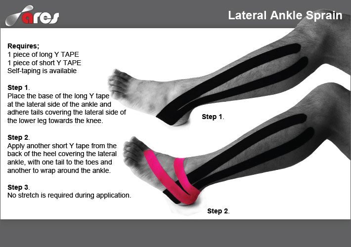 Lateral-Ankle-Sprain1