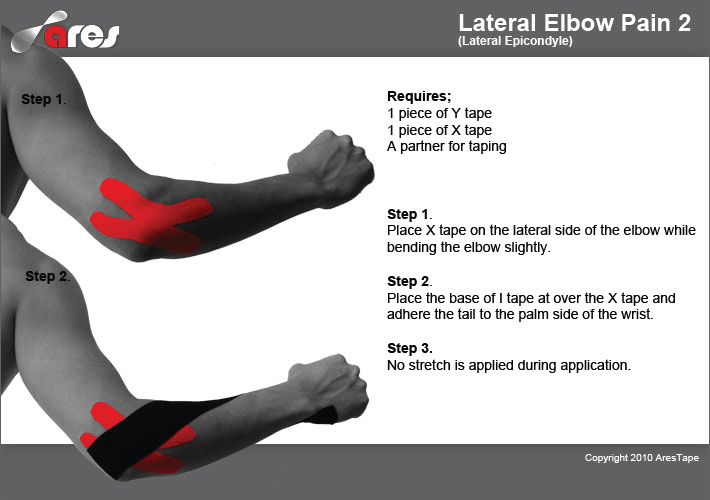 Lateral-Elbow-Pain-2